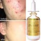 Salicylic Acid Acne Removal Serum Effective Acne Treatment Repair Spots Scar Moisturizing Oil Control Shrink Pore Skin Care